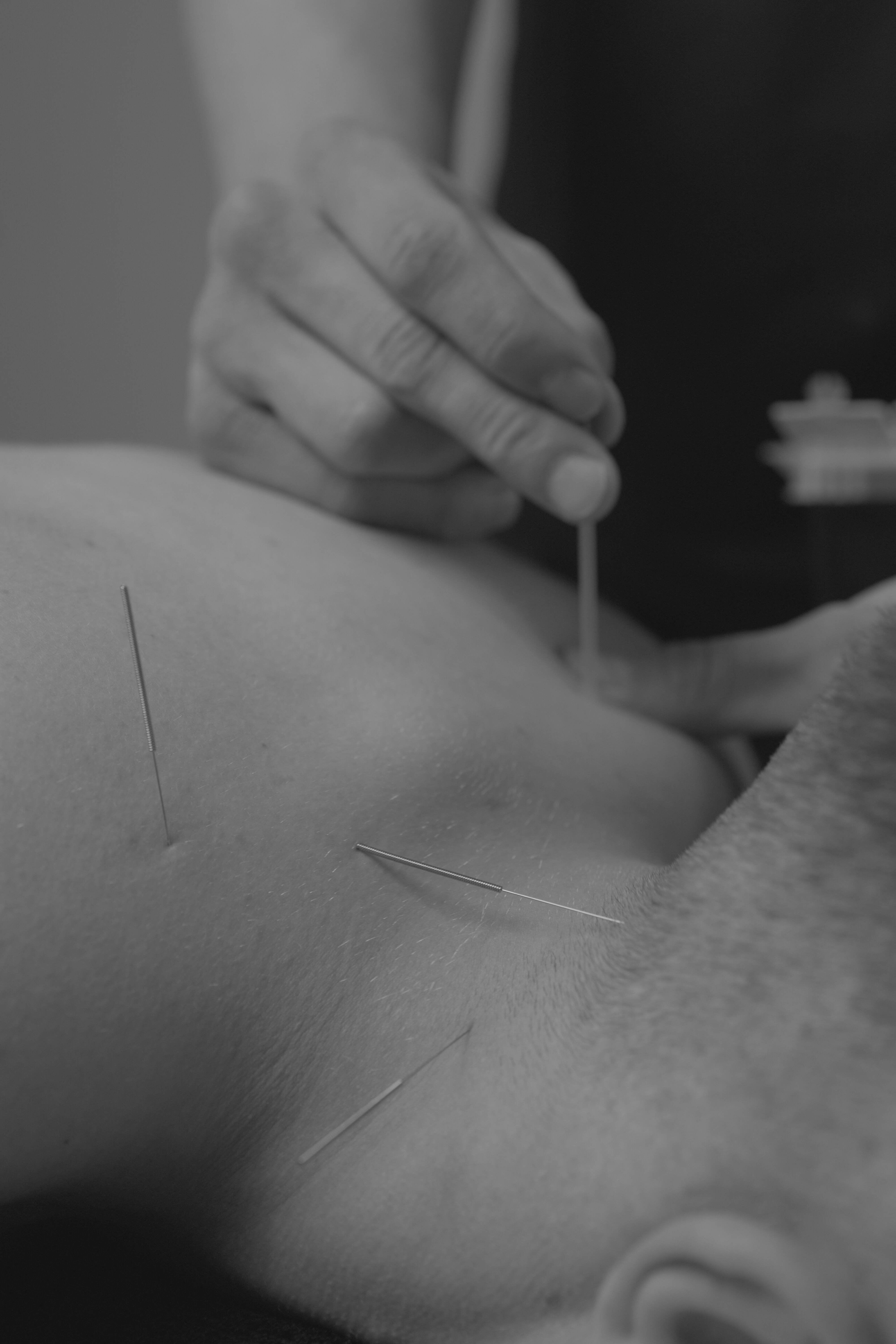 Голкорефлексотерапія